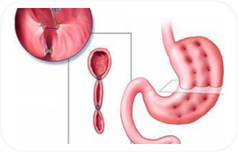 Endoscopic Gastric Sleeve