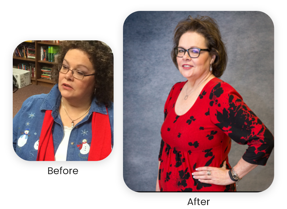 Debbie — actual NuSelf patient — Antes y después · Los resultados varían.