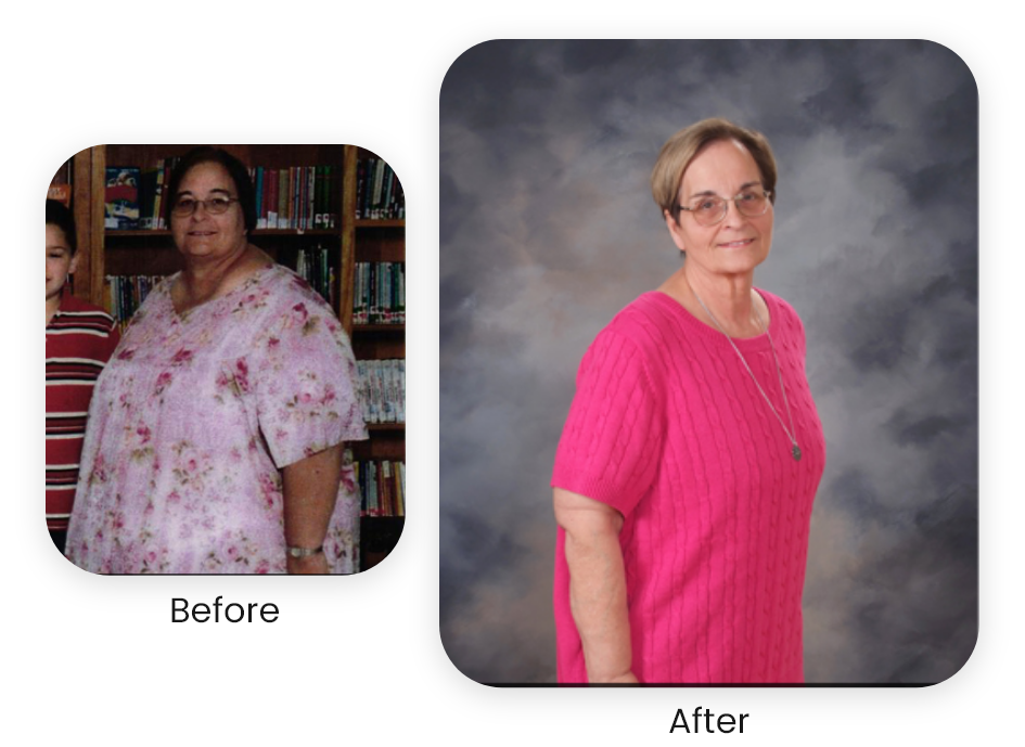 Ellen — actual NuSelf patient — Antes y después · Los resultados varían.