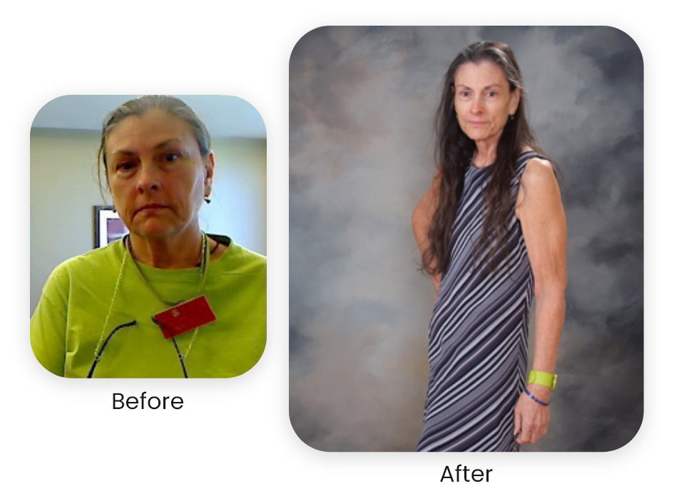 Linda — actual NuSelf patient — Antes y después · Los resultados varían.