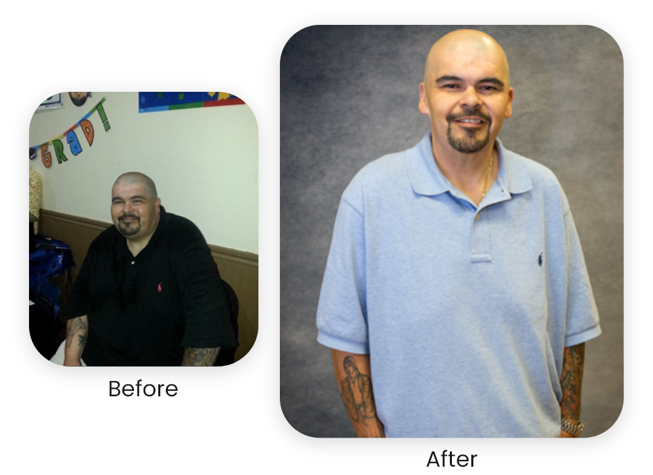 Raymond — actual NuSelf patient — Antes y después · Los resultados varían.