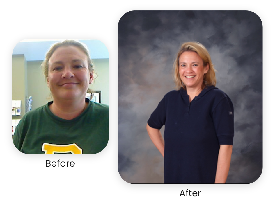 Rebecca — actual NuSelf patient — Antes y después · Los resultados varían.