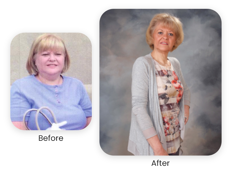 Sherry — actual NuSelf patient — Antes y después · Los resultados varían.